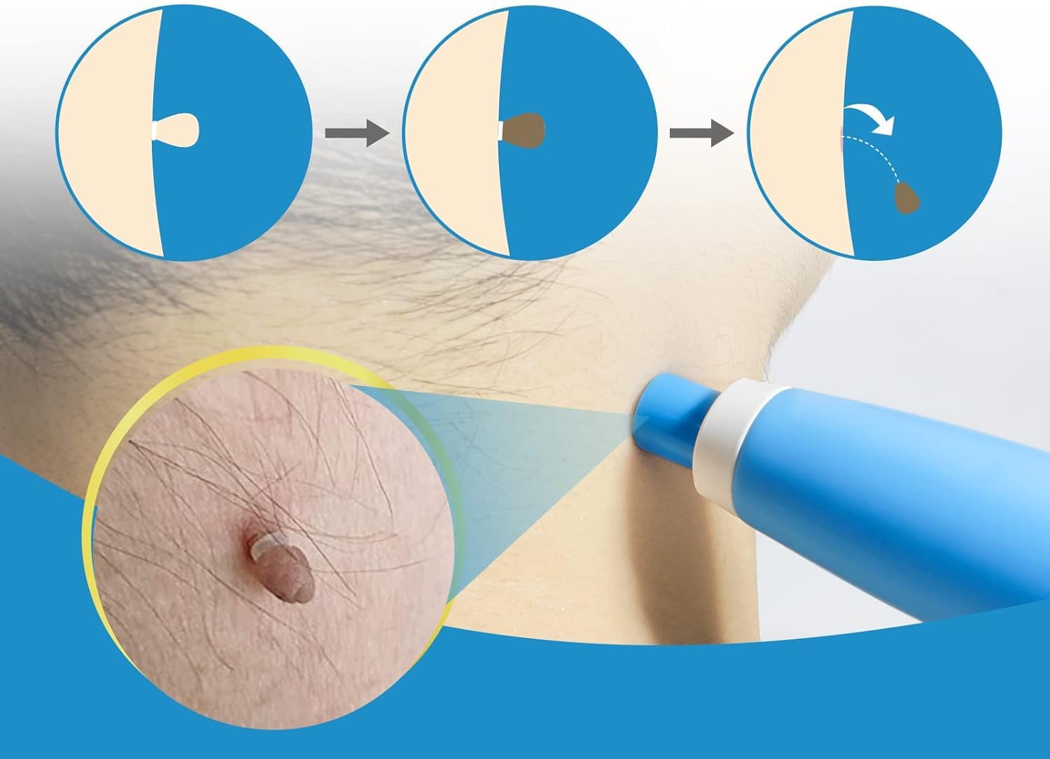 Painless Auto Skin Tag & Mole  - огляд і ціна Health Wellness