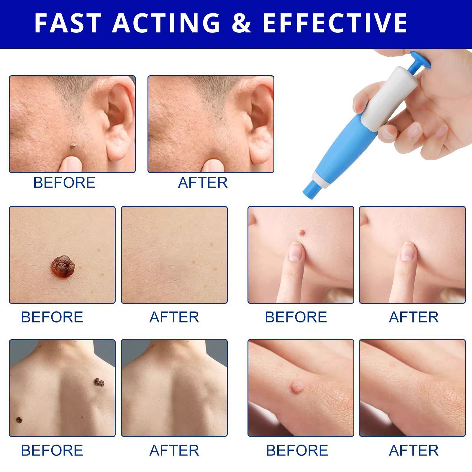 Painless Auto Skin Tag & Mole  - огляд і ціна Health Wellness