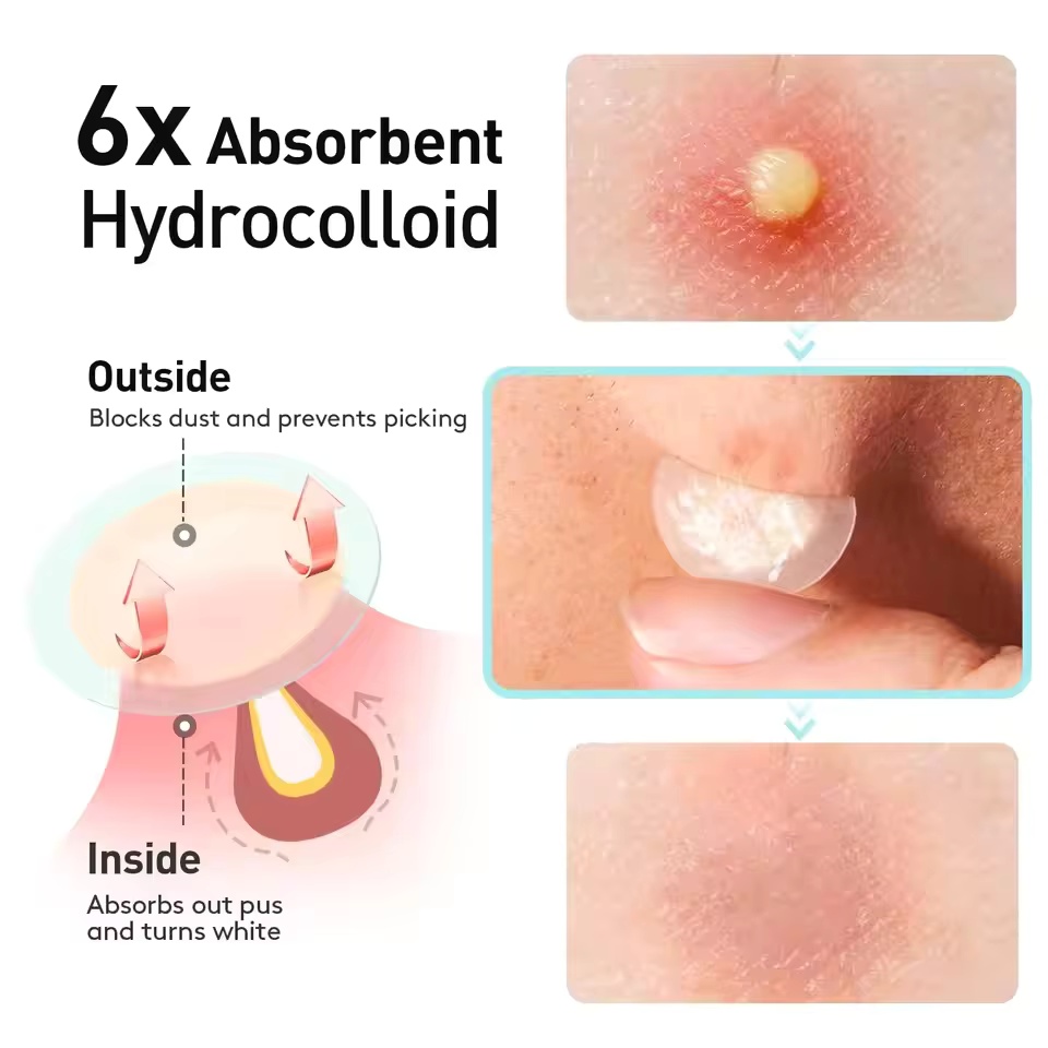 360 pieces/box acne patches -  - огляд і ціна Essential Oils
